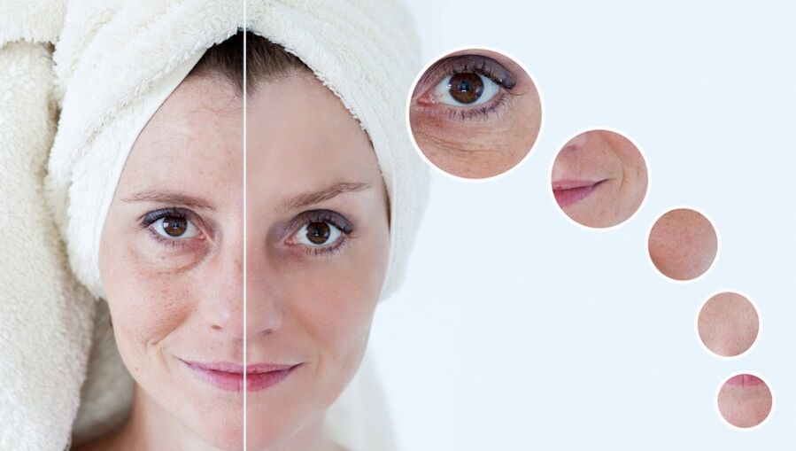 antes y después del rejuvenecimiento de la piel con plasma