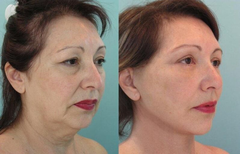 El resultado del rejuvenecimiento de la piel del rostro tensando con hilos. 